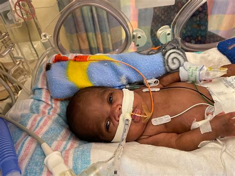 Alabama Boy Born 19 Weeks Early Sets World Record For Most Premature