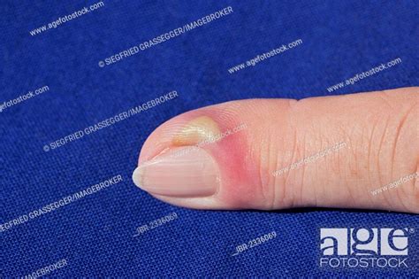 Bacterial Infection Inflammation Index Finger Pus Abscess Stock