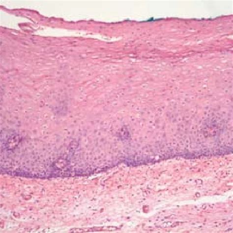 This Photomicrograph Of A Re Biopsy Specimen Suggests A Diagnosis Of