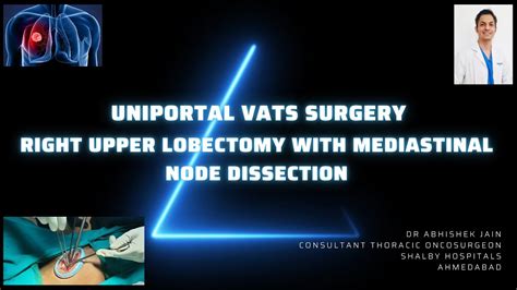 Uniportal Vats Right Upper Lobectomy With Systematic Mediastinal Lymph