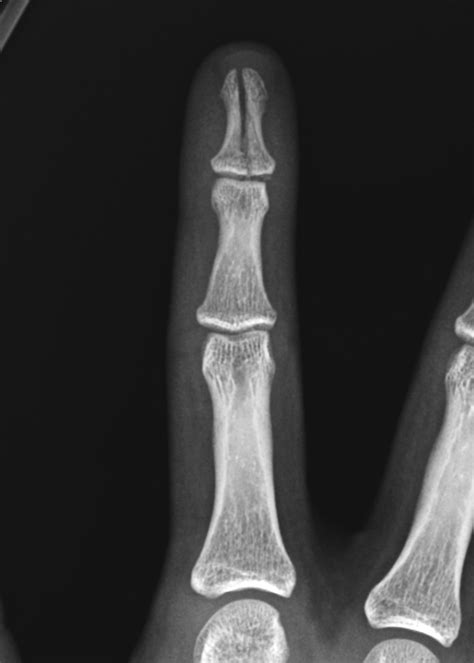 Phalanx Fractures Hand Orthobullets