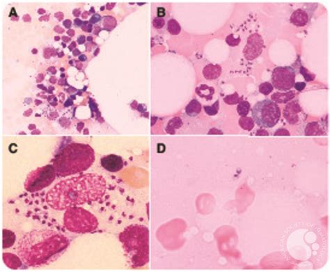 Pancytopenia Caused By Visceral Leishmaniasis In A Patient
