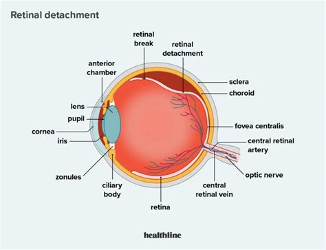 Retinal Detachment Medishark