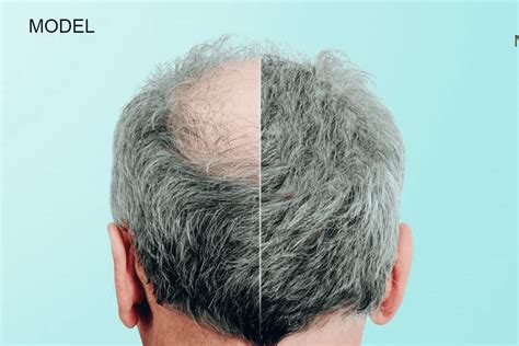 How A Follicular Unit Transplantation Fut Works For Hair Restoration