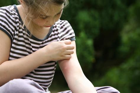 Quick And Easy Ways To Treat Mosquito Bites At Home
