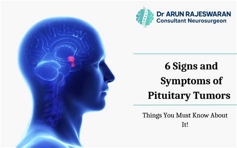 6 Signs And Symptoms Of Pituitary Tumors