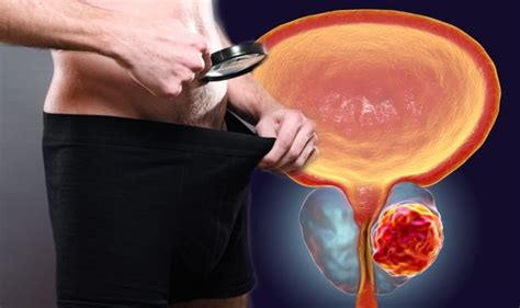 Prostate Cancer Symptoms If You See This In Your Semen Do Not Ignore Warning Sign Express Co Uk