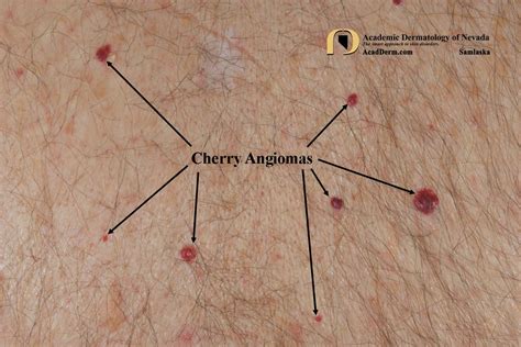 Cherry Angioma Senile Angioma Academic Dermatology Of Nevada