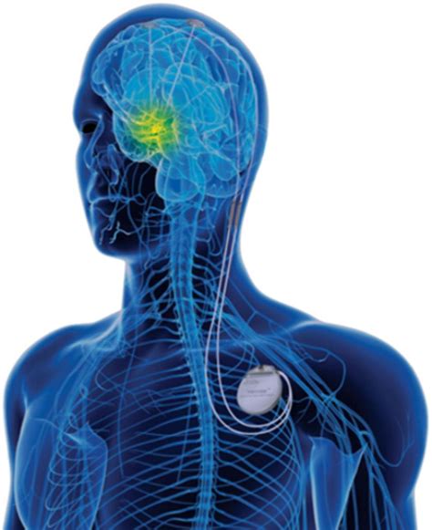 Deep Brain Stimulation Practical Insights And Common Queries