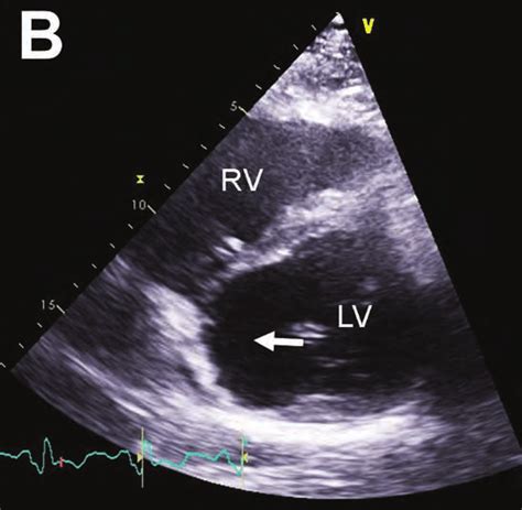 Two Dimensional Transthoracic Echocardiography In The A Apical