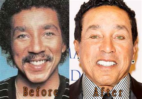 We did not find results for: Smokey Robinson Plastic Surgery Before and After - Top ...