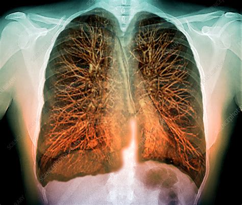 However, all the lobes help in the exchange of gases and aid breathing. Lungs, 3D MRI scan - Stock Image - P590/0282 - Science ...
