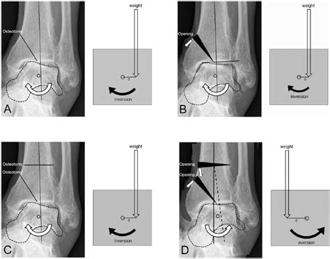 Novel Double Osteotomy Technique Of Distal Tibia For Correction Of