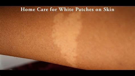 10 Reasons Of White Patches Or Spots On Your Skin 10