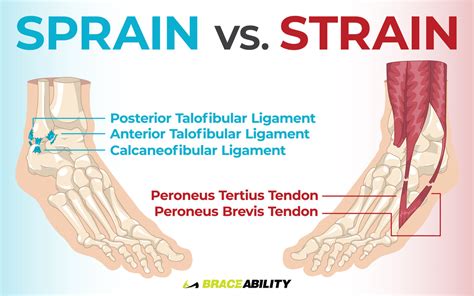 A Sprain A Twist Or A Roll Decipher Your Ankle Injury