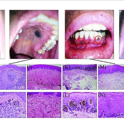 Comparison Of Benign Lesions And Malignant Oral Mucosal Melanoma