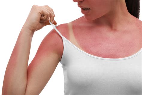 A Guide To Sunburn Factors And Recommended Treatments