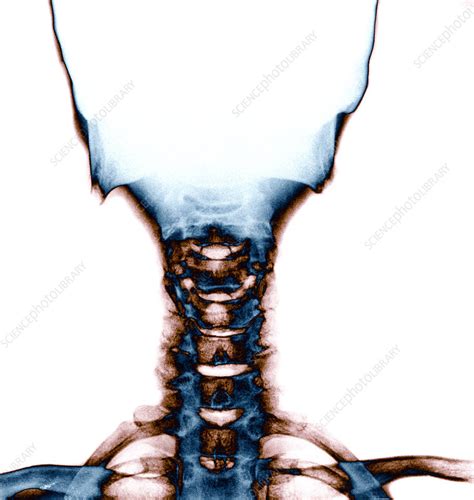 Neck And Skull X Ray Stock Image P1160491 Science Photo Library