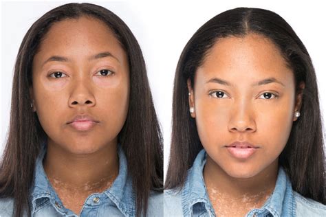 Vitiligo Makeup Before And After Saubhaya Makeup