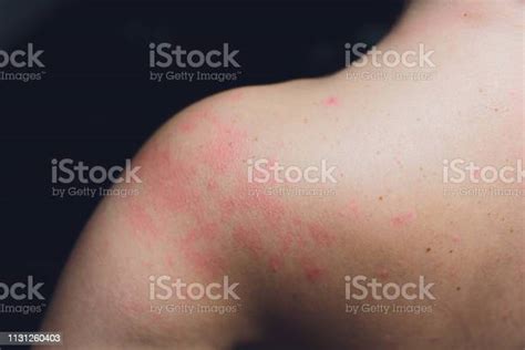 Close Up Allergy Rash Around Back View Of Human With Dermatitis Problem