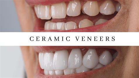 Ceramic Veneer Cases About Tooth Dental Clinic