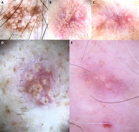 Dermatofibroma With Sebaceous Induction Dermoscopic Clues To Improve