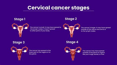 What Do The 4 Stages Of Cancer Mean Best Design Idea