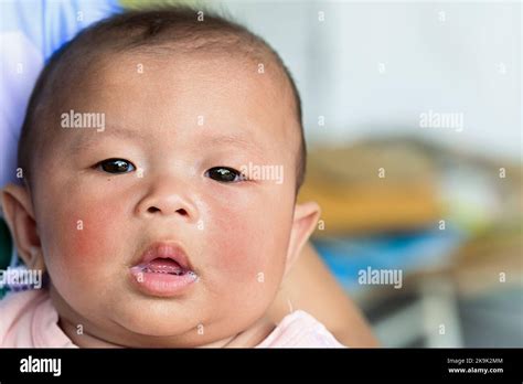 Rash On Baby Face Baby With Dermatitis Problem Of Rash Allergy