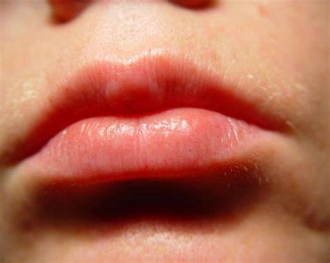 Tingling Or Numb Lips Causes Symptoms Treatment Healthmd