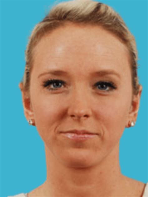 Adult Otoplasty Utah Mobley MD Facial Plastic Surgeon