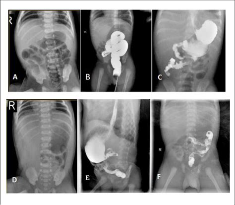 Figure 2 From Congenital Short Bowel Syndrome Is Associated With A