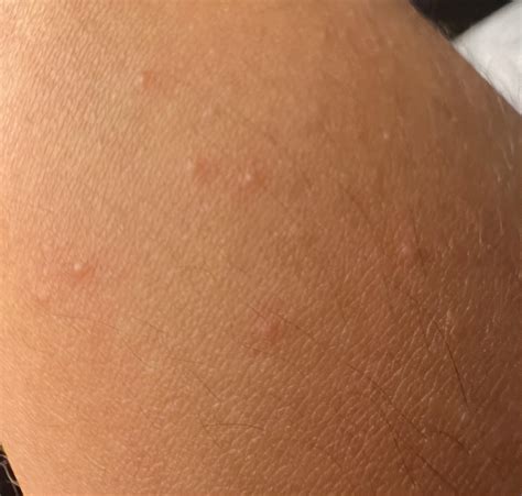 Itchy Bumps Only On One Forearm Dermatologyquestions