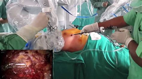 Myasthenia Gravis Robotic Thymectomy Surgery Youtube