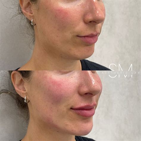 Jawline And Chin Fillers Sm Aesthetic Lab Cosmetic Clinic Sydney