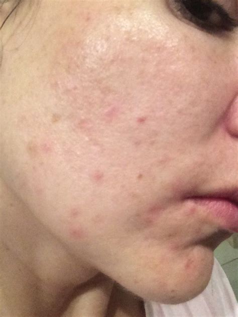The Ordinary Results Before And After Pictures Acne Treatment The