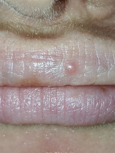 Recurring Bump On Lips Is This A Cold Sore Clinic Said Probably Not