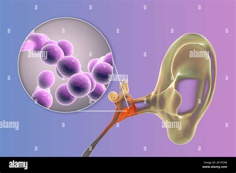 Chronic Fungal Otitis Media Ear Infection Illustration Stock Photo Alamy