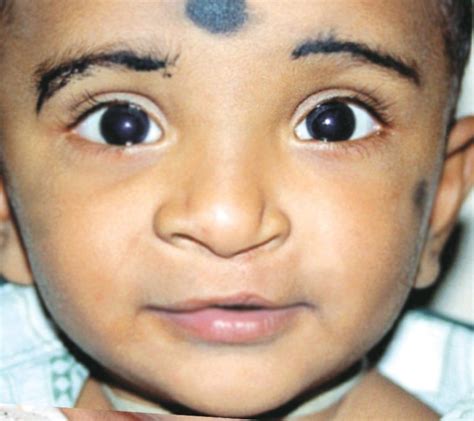 Treatment For Cleft Lip And Palate Cleft Lip Surgeon In India