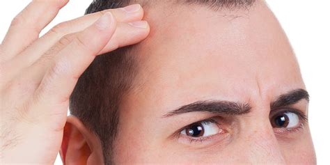 Temple Hair Loss Causes And Treatment Options For Males Females