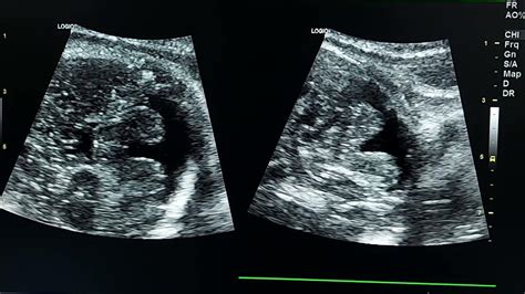 Dandy Walker Malformation Prenatal Ultrasound Youtube