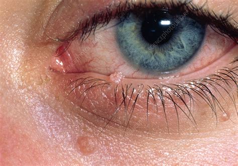 Molluscum Contagiosum Infection Of Lower Eyelid Stock Image M210