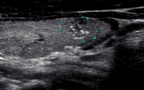 Figure 1 Thyroid Microcalcifications Commonly Seen In Papillary