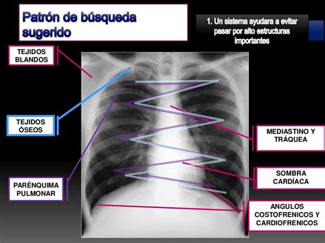 Interpretacion De Radiografia Pa De Torax O Tele De Torax