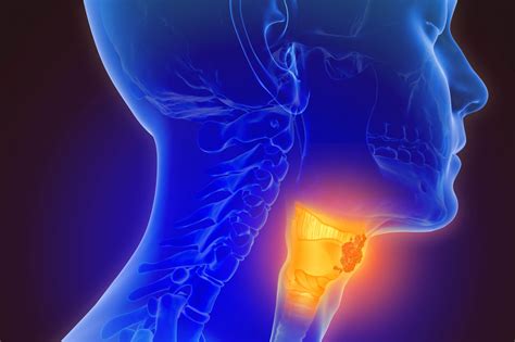 What Does Throat Cancer Feel Like Roswell Park Comprehensive Cancer