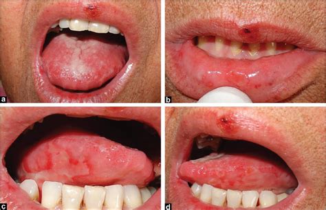 The best way to treat a herpes outbreak / patient. View Image