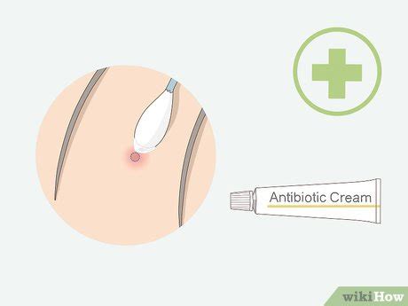 How To Get Rid Of Ingrown Pubic Hair With Pictures Wikihow