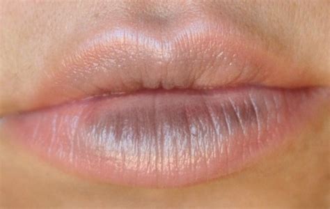 what causes lips to turn blue