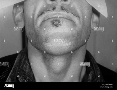 Syphilitic Hi Res Stock Photography And Images Alamy