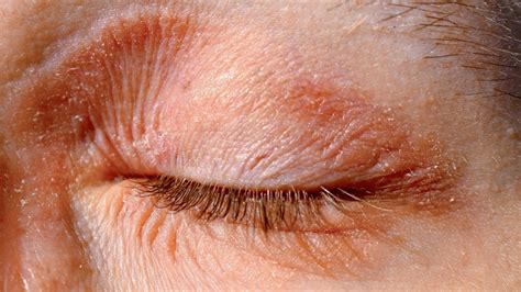 Eczema On The Eyes Causes Symptoms And Treatment