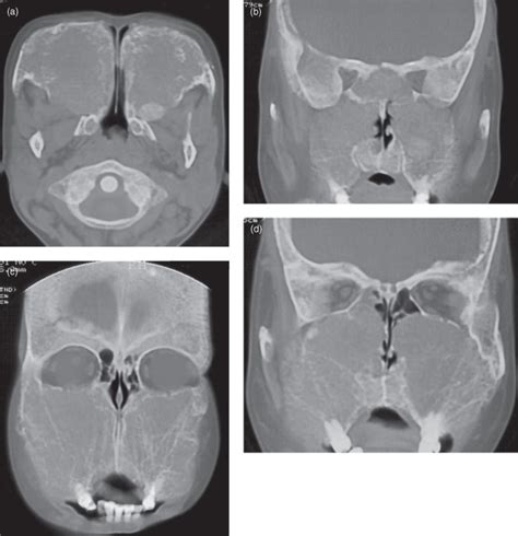 11 Maxillary Antrum Pocket Dentistry